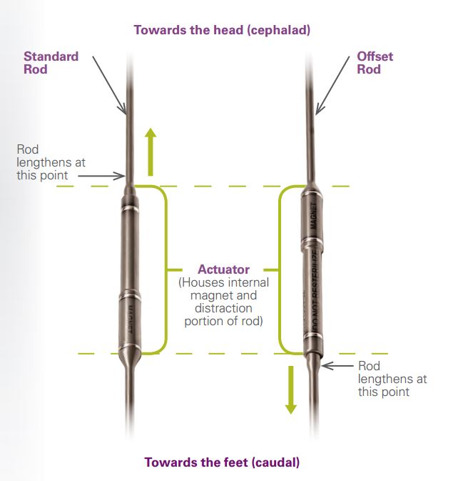 Scoliosis System Designed for Kids to Grow with Treatment Medical